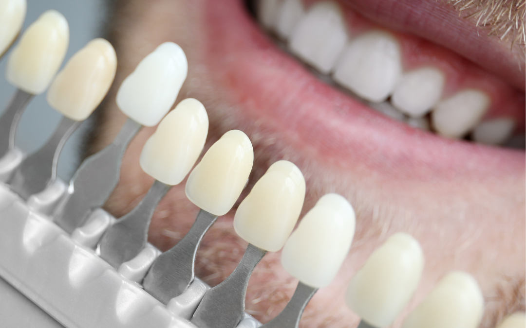 Veneers: Transforming Smiles with Seamless Aesthetics at Gidel Family Dentistry